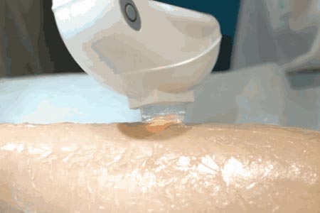 去正規(guī)醫(yī)院脫毛多少錢大概？全面了解脫毛費(fèi)用，正規(guī)醫(yī)院脫毛費(fèi)用全面解析，脫毛大概需要多少錢？