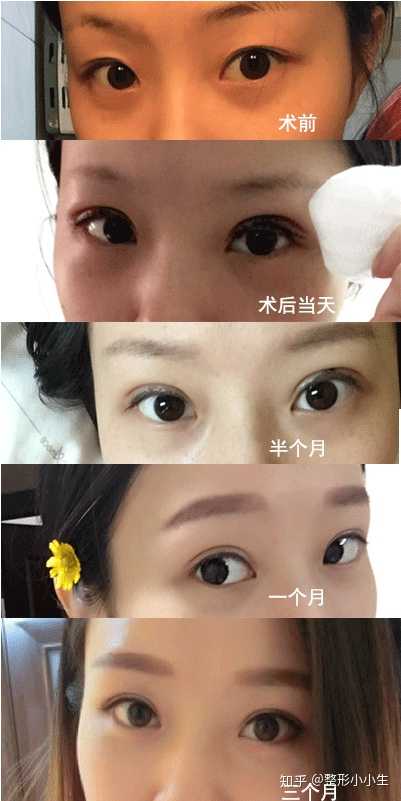 全切雙眼皮恢復過程圖，詳細解讀恢復之旅，全切雙眼皮恢復全程詳解，恢復過程圖助你順利度過恢復之旅