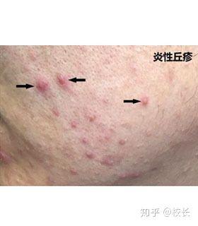 臉上痘痘頻發(fā)？揭秘有效去除痘痘的方法，揭秘有效去除痘痘的方法，告別頻發(fā)痘痘臉