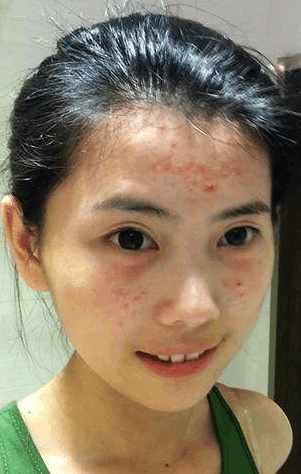 臉上痘痘去除小竅門(mén)，自然、健康的方法幫助你重拾肌膚光彩，自然健康的小竅門(mén)，重拾肌膚光彩的痘痘消除法