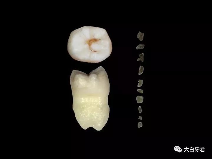牙齒凹槽上面有黑色——原因、影響及解決方案，牙齒凹槽黑色沉積，原因、影響與解決方案全解析