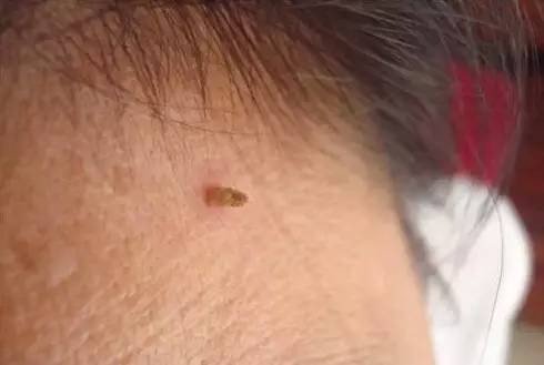 脖子上長(zhǎng)小肉疙瘩，原因、診斷與治療方法，脖子上長(zhǎng)小肉疙瘩，原因、診斷及治療方法全解析