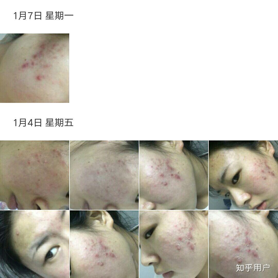 維A酸乳膏，了解真相，避免誤解與恐慌，維A酸乳膏真相解析，避免誤解與恐慌的指南