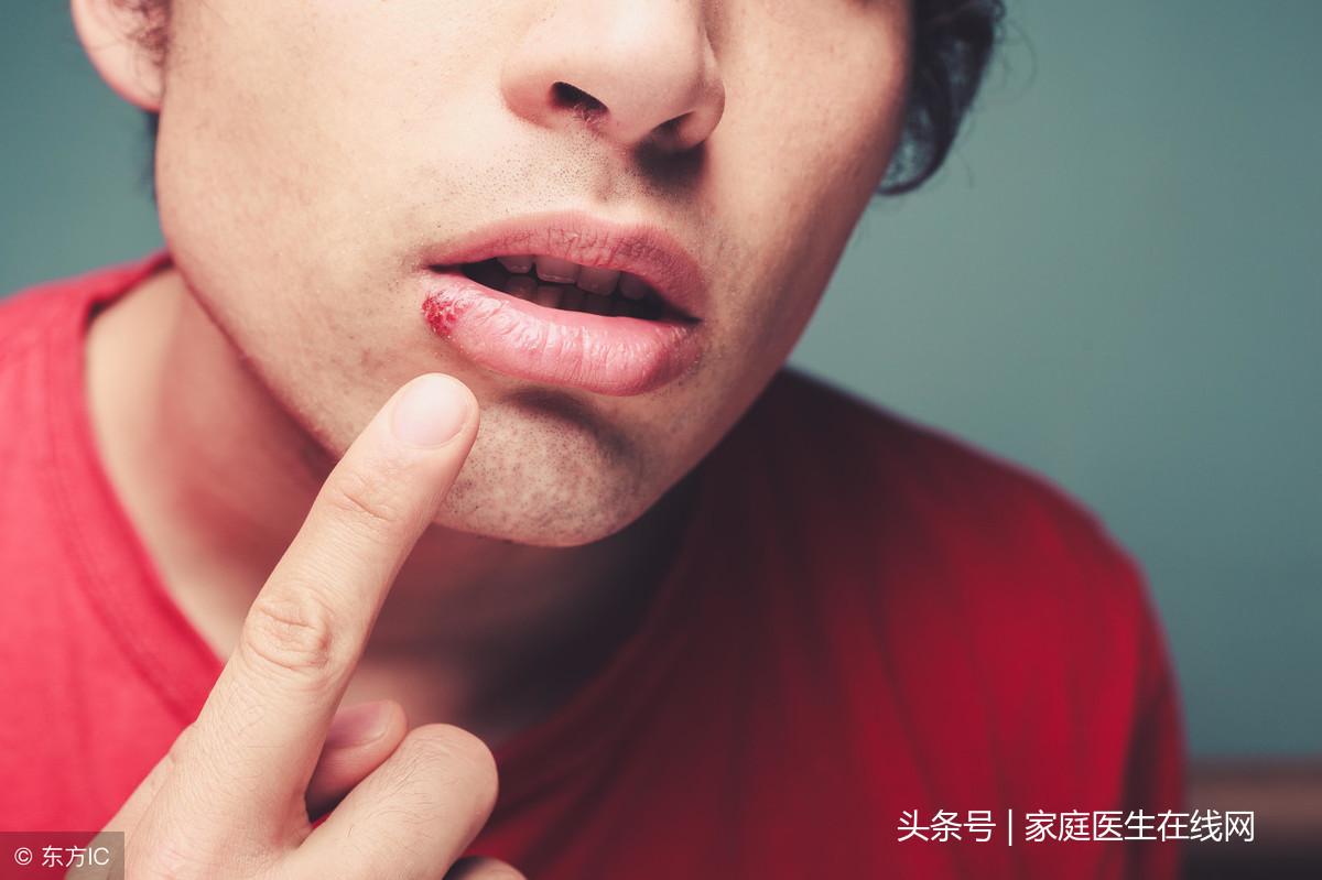 嘴唇上火起泡如何快速消除，全面指南與實(shí)用建議，嘴唇上火起泡全面解決指南，快速消除方法與實(shí)用建議