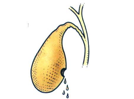 膽結(jié)石最佳治療方法，全面解析與選擇，膽結(jié)石最佳治療方法詳解，全面解析與選擇策略