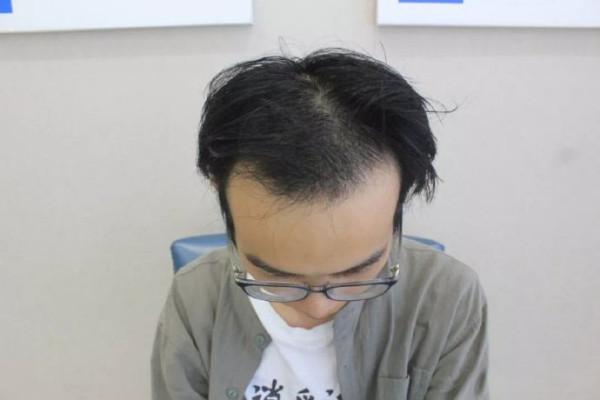 植發(fā)價格全面解析，一般植發(fā)需要多少錢？，植發(fā)價格全面解析，一般植發(fā)費用是多少？