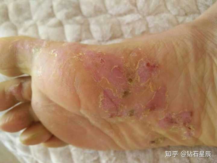 治療腳氣，探尋最有效藥物，告別腳部困擾，告別腳氣煩惱，探尋最有效的治療藥物！