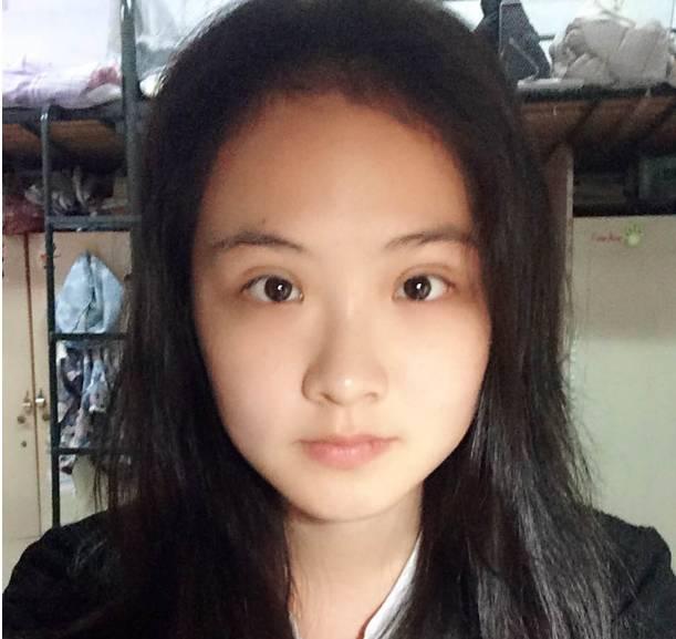 雙眼皮二次修復最佳時間解析，雙眼皮二次修復的最佳時機解析