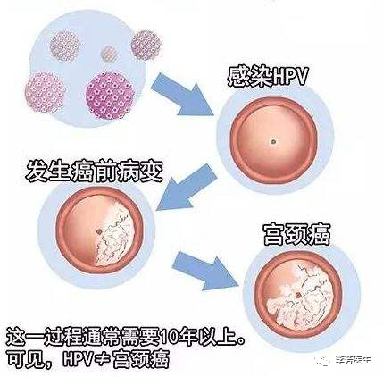 女性感染HPV后下面可能出現(xiàn)的癥狀與影響，女性感染HPV后的癥狀與影響，私密部位可能出現(xiàn)的癥狀解析