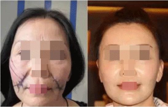 面部松弛下垂提升最有效的方法，重塑緊致輪廓的秘訣，重塑緊致輪廓秘訣，面部松弛下垂提升的有效方法