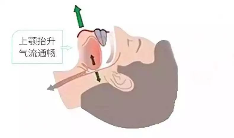 教你一招，快速讓鼻子通氣，只需20秒！，快速通氣妙招，20秒內(nèi)讓鼻子通暢！
