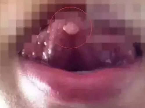 女性尖疣早期癥狀圖片與識(shí)別，了解并預(yù)防的重要性，女性尖疣早期癥狀識(shí)別與預(yù)防，圖片詳解及重要性了解