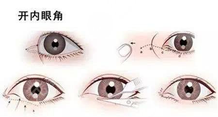 開(kāi)眼角手術(shù)的風(fēng)險(xiǎn)與危害深度解析，開(kāi)眼角手術(shù)風(fēng)險(xiǎn)與危害全面解析