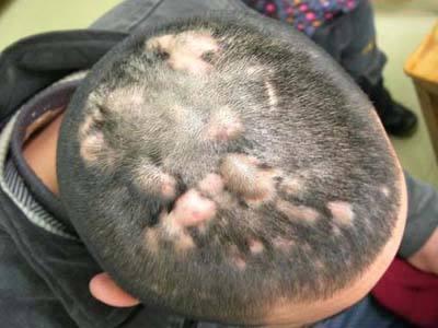 毛囊炎怎么治才能除根？全面解析最佳治療方法，全面解析毛囊炎最佳治療方法，根治不復(fù)發(fā)！