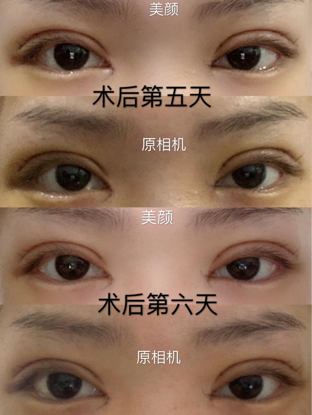 雙眼皮手術(shù)哪個(gè)醫(yī)院做的比較好，全面解析與選擇指南，雙眼皮手術(shù)醫(yī)院選擇指南，全面解析與推薦