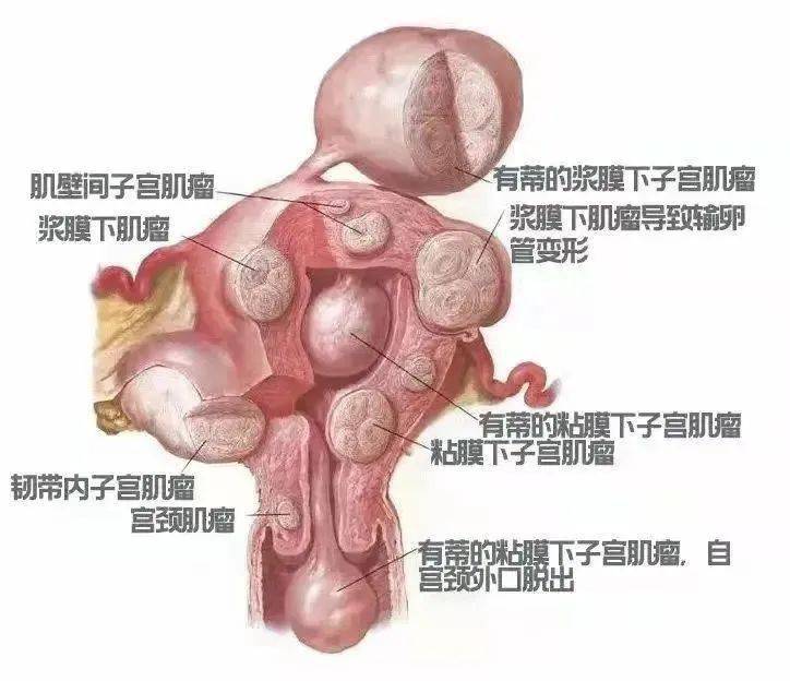 子宮肌瘤多大必須手術(shù)切除，全面解析與關(guān)注，子宮肌瘤手術(shù)切除的臨界解析與關(guān)注焦點(diǎn)