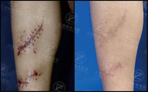手術(shù)疤痕能否徹底去除？全面解析手術(shù)疤痕修復(fù)與去除方法，手術(shù)疤痕修復(fù)與去除方法全面解析，能否徹底去除手術(shù)疤痕？
