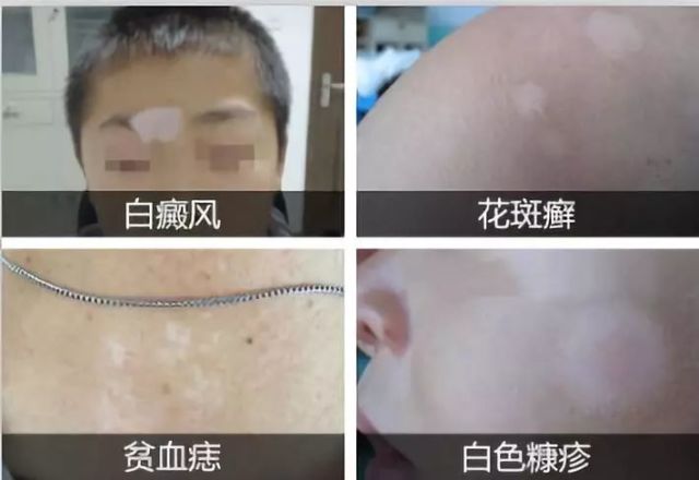 在家如何自測(cè)白斑，簡(jiǎn)單有效的自我檢查方法，在家如何簡(jiǎn)單有效自測(cè)白斑，自我檢查方法指南
