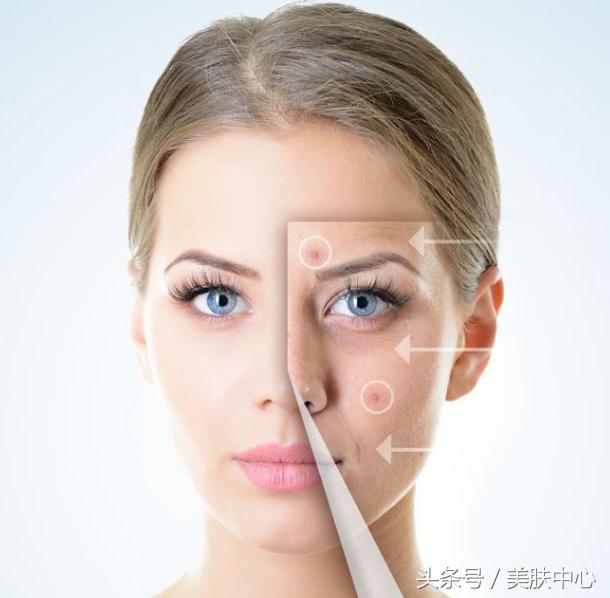 如何去除痘印，最有效的方法和建議，如何有效去除痘印，方法與建議全解析