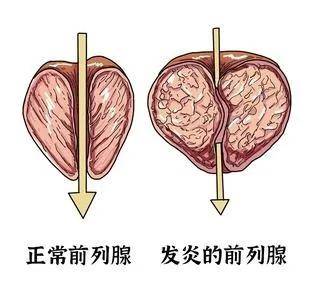 三個(gè)簡(jiǎn)單動(dòng)作，有效緩解前列腺炎癥狀，三個(gè)動(dòng)作緩解前列腺炎癥狀