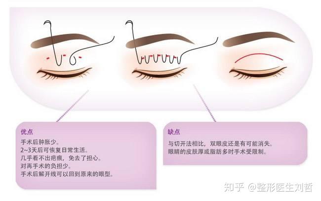 全切與埋線雙眼皮手術(shù)，哪個更適合你？，全切與埋線雙眼皮手術(shù)，哪個更適合你？對比解析與選擇建議。
