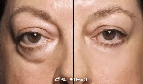 大眼袋消除術(shù)，揭秘去掉大眼袋的有效方法，揭秘大眼袋消除術(shù)，有效去除大眼袋的方法