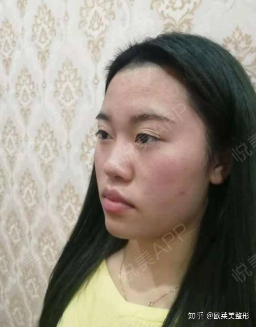 鼻子大怎樣變小不整容——自然縮小鼻子的方法，自然縮小鼻子的方法，不整容讓鼻子變小的秘訣