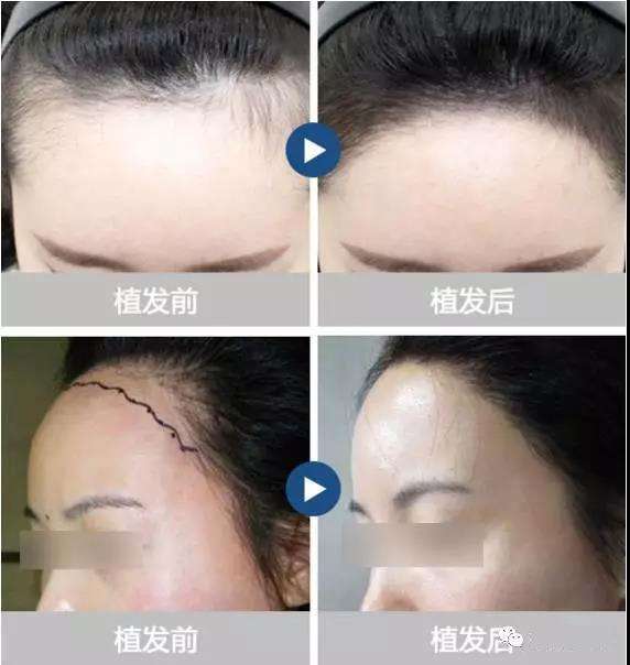 植發(fā)的最佳年齡，探尋最佳頭發(fā)移植時(shí)機(jī)，探尋最佳植發(fā)年齡，掌握頭發(fā)移植最佳時(shí)機(jī)