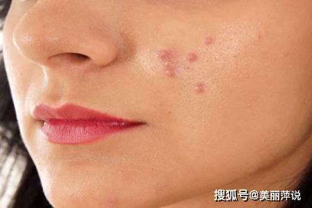 內分泌失調老長痘痘，如何有效排毒？，內分泌失調易引發(fā)痘痘，有效排毒是關鍵之道