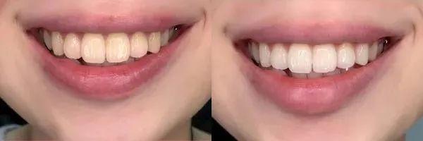 牙齒黃了怎么變白最簡單的方法，牙齒變黃如何簡單美白？有效方法大揭秘