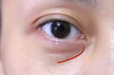 去除眼袋