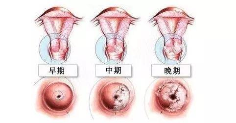 女性掉頭發(fā)是癌癥前兆嗎？解讀真相與誤解，女性脫發(fā)與癌癥關(guān)系真相解讀，是前兆還是誤解？