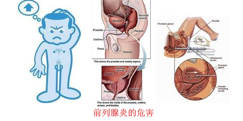 前列腺炎的最佳治療方法，全面解析與指導(dǎo)，全面解析指導(dǎo)，前列腺炎的最佳治療方法