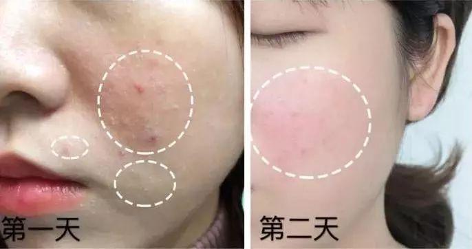 三天去青春痘的小妙招，快速有效的護(hù)膚方法，三天快速去青春痘小妙招，有效護(hù)膚方法分享