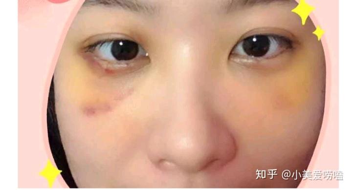 激光去眼袋視頻全過(guò)程詳解，從入門(mén)到精通，激光去眼袋全過(guò)程詳解，從入門(mén)到精通的視頻教程