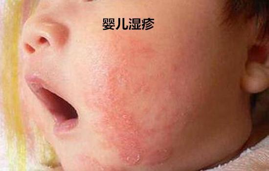 熱疹和濕疹的圖片，識(shí)別與應(yīng)對(duì)，熱疹和濕疹，識(shí)別、對(duì)比與應(yīng)對(duì)方法（含圖片）