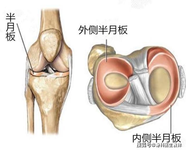 半月板損傷能自愈嗎？解析損傷程度與恢復(fù)可能性，半月板損傷程度與恢復(fù)可能性解析，能否自愈？