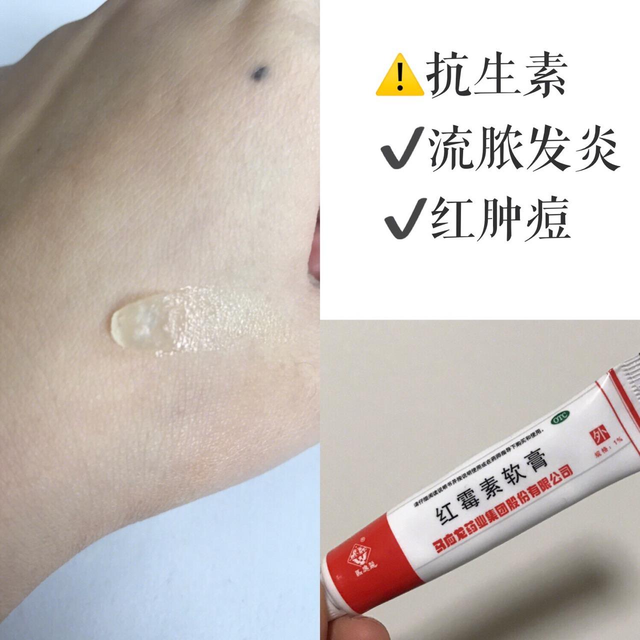 紅霉素軟膏可以祛痘嗎？解析真相與注意事項(xiàng)，紅霉素軟膏能否祛痘？真相解析及注意事項(xiàng)探討