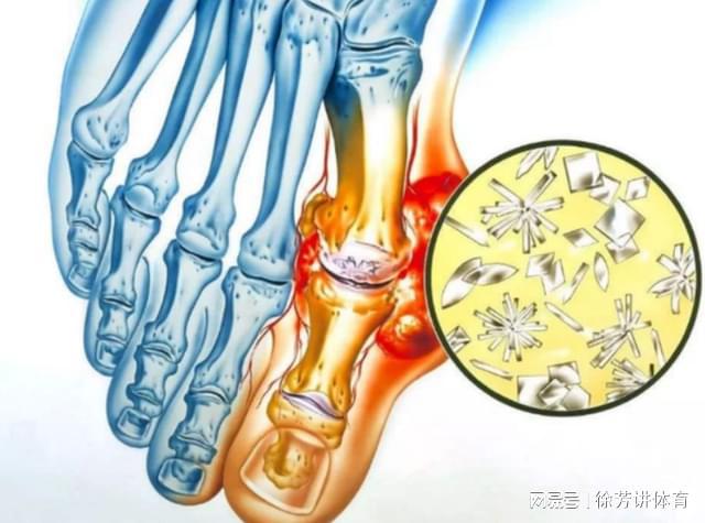 尿酸克星第一名，揭秘降低尿酸的神秘武器，揭秘，降低尿酸的神秘武器，尿酸克星第一名！