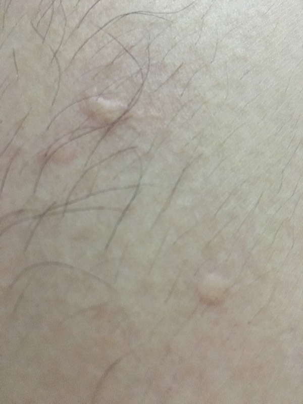 身上無端起包癢，像是蚊子咬的——原因解析與防治策略，身上無端起包癢，疑似蚊蟲叮咬，原因、解析及防治策略