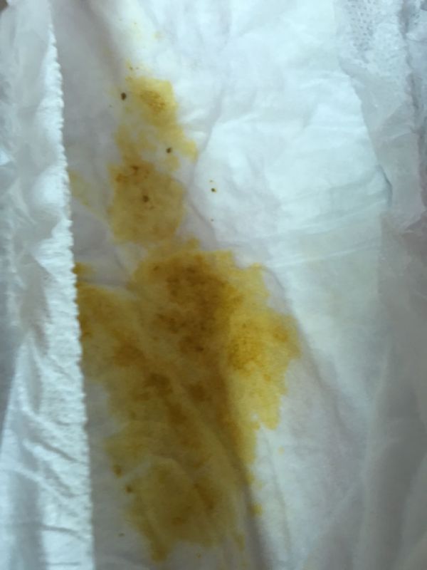 大便像水一樣噴出來怎么回事，大便呈噴射狀，原因解析