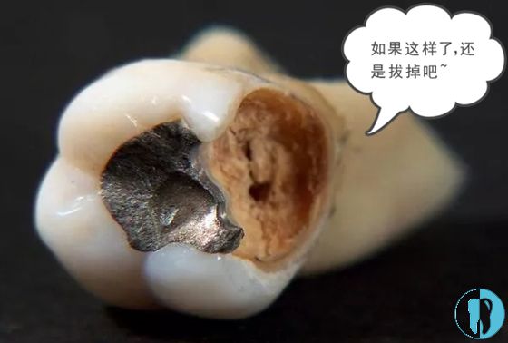 后悔把爛牙根拔了嗎？解讀牙齒拔除的利弊與決策過程，后悔拔爛牙根了嗎？牙齒拔除的利弊分析與決策過程解讀