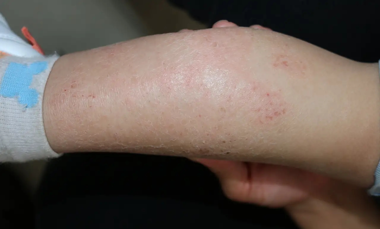 過敏性皮炎濕疹，了解、預防與治療，過敏性皮炎濕疹，全面解析、預防與治療方法