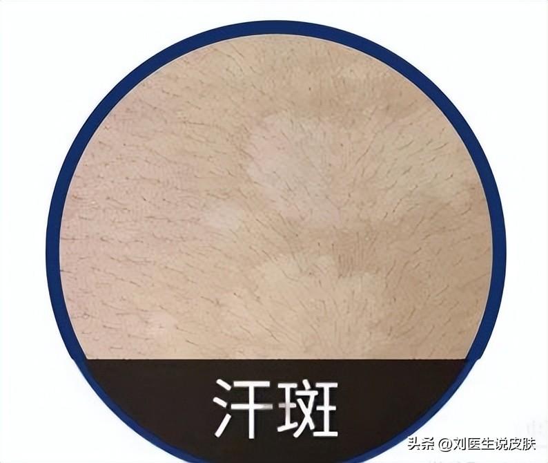 白點(diǎn)癲風(fēng)治療指南，全面解析白點(diǎn)癲風(fēng)的治療方法，白點(diǎn)癲風(fēng)治療全面解析與指南