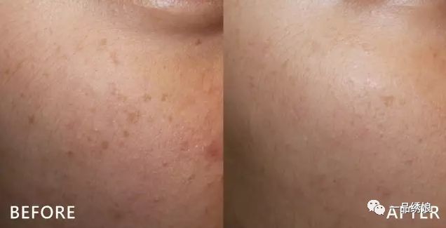 光子嫩膚兩年后毛孔逐漸增大，原因及解決方案探討，光子嫩膚兩年后毛孔逐漸增大，原因解析與解決方案探討