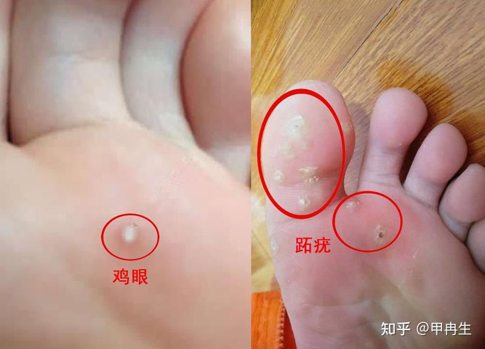 如何分辨雞眼和跖疣——深入了解兩種足部問(wèn)題的差異，雞眼與跖疣的分辨，足部問(wèn)題的深度解析