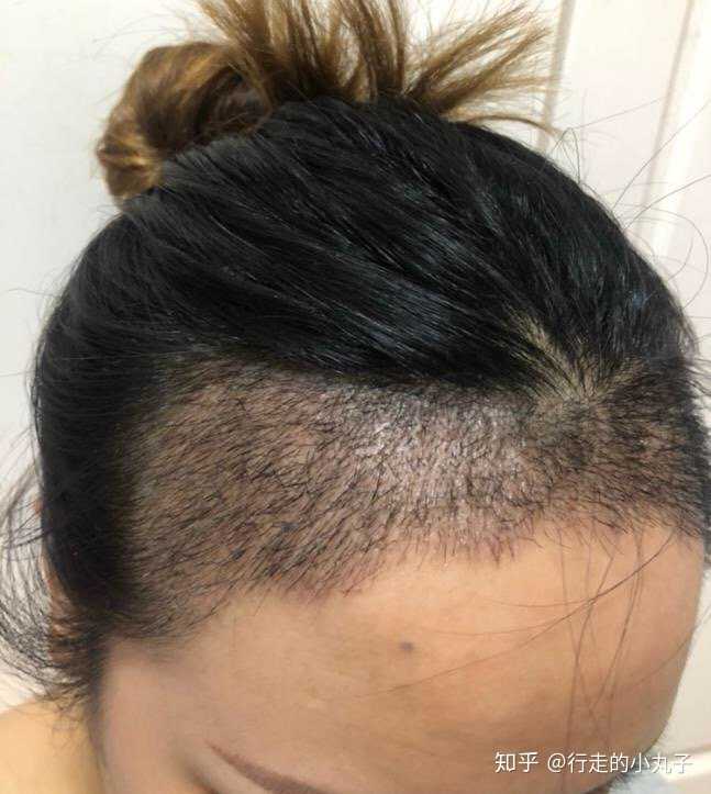 如何讓發(fā)際線慢慢變低——打造美麗新發(fā)型，打造美麗新發(fā)型，降低發(fā)際線的秘訣與技巧