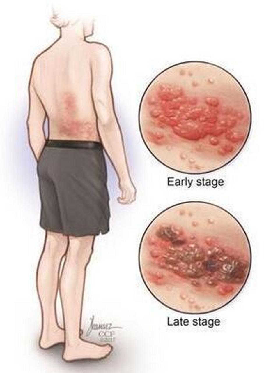 皰疹是否為性疾病，全面解析與理解，皰疹解析，是否為性疾病的全面解讀與理解
